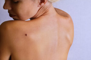 woman looking at a mole in her back